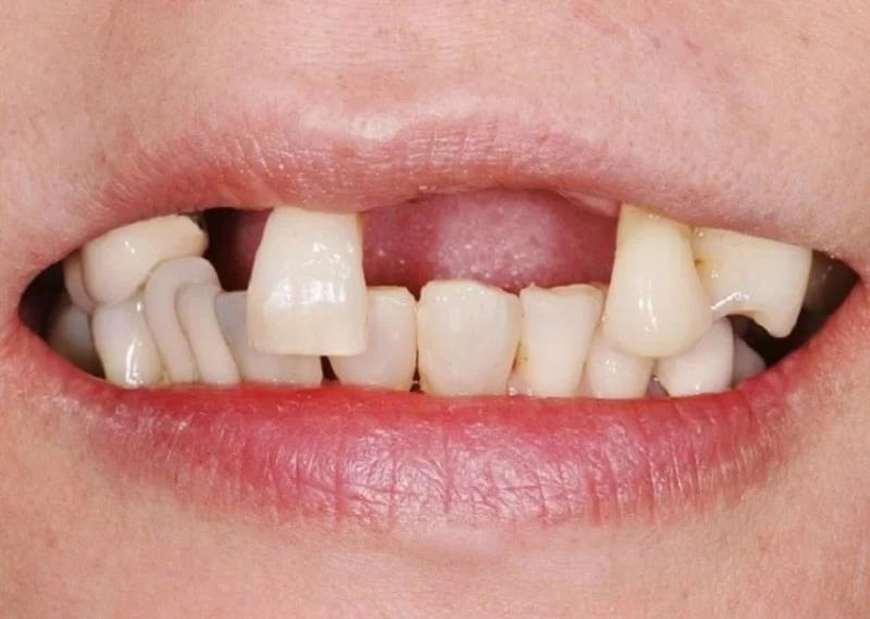 Nhiều người cho rằng mơ thấy rụng răng là một điềm báo cực kỳ xấu